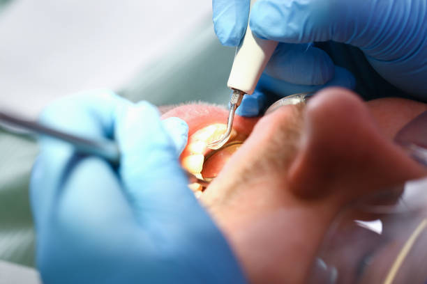 Best Emergency Dental Extractions in Wellman, IA